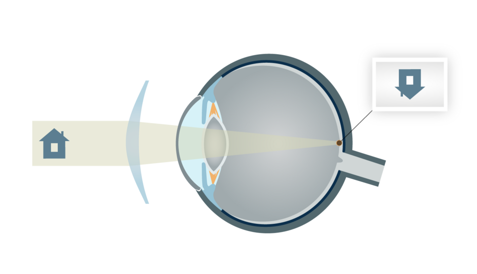 Hypermétropie avec verre convergent, dit positif Hypermétropie avec verre convergent, dit positif