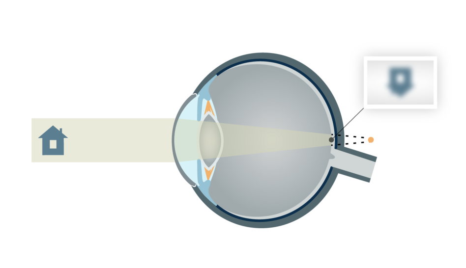 Hypermétropie sans verre positif Hypermétropie sans verre positif